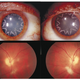 Illustration for article titled A 14,000-volt electrical shock gave this man star-shaped cataracts